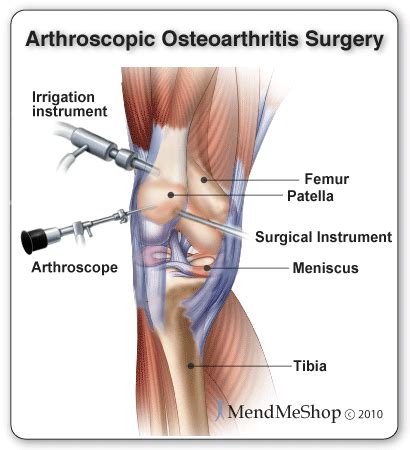 Surgical Treatments for Knee Osteoarthritis