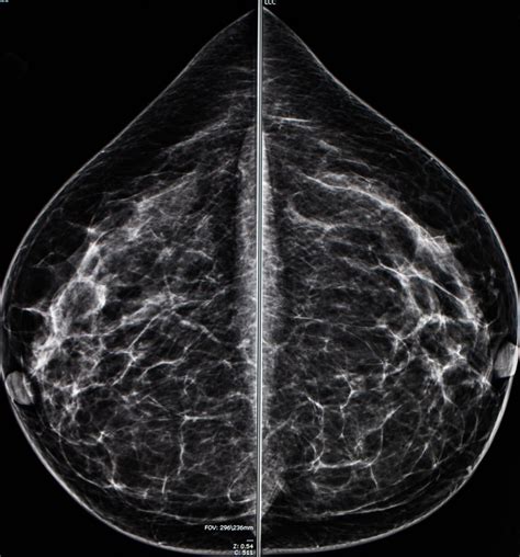 Mammogram radio imaging for breast cancer diagnosis - ODC