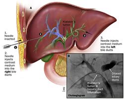 Percutaneous Transhepatic Biliary Drainage (Ptbd)