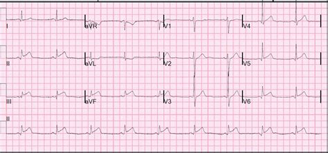 Dr. Smith's ECG Blog: Inferior STEMI: can we predict the infarct ...