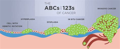 The ABCs and 123s of Cancer Stages