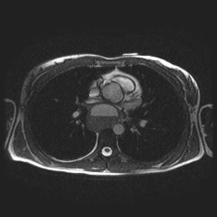 Esophageal duplication cyst | Radiology Reference Article | Radiopaedia.org