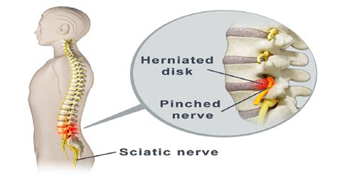 Try These 2 Highly Effective Solutions to Release the Pinched Nerve in ...