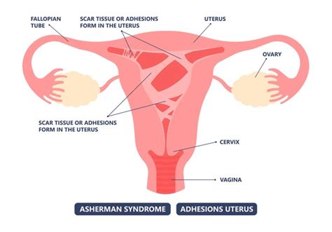 3 Atrofia Endometrial Images, Stock Photos, 3D objects, & Vectors ...