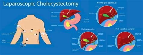 Laparoscopic Cholecystectomy - Indications, Preparation & Recovery