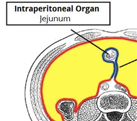 Reversal of a Loop Stoma - Ileostomy - Colonostomy - TeachMeSurgery