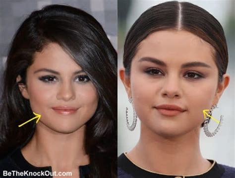 Selena Gomez Plastic Surgery Comparison Photos