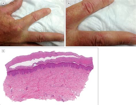 Lifelong Desquamation of the Hands and Feet | Dermatology | JAMA ...