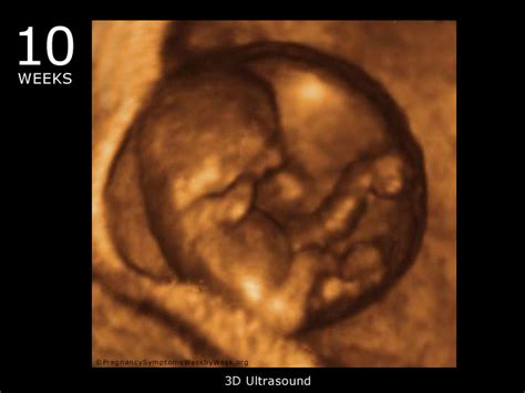 10 Week 3D Ultrasound Baby Picture | Pregnancy Symptoms Week by Week