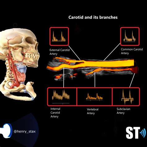 Carotid Duplex – Sonographic Tendencies