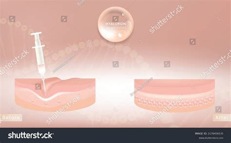 Hyaluronic Acid Before After Hair Skin Stock Vector (Royalty Free ...