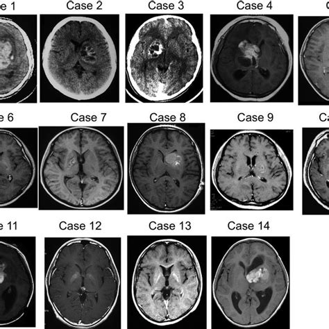 Delay from symptom onset to diagnosis or treatment in cases of ...