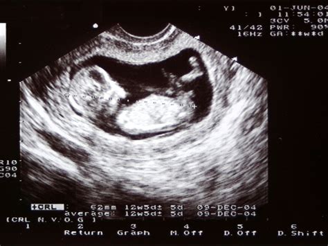 12 Week Ultrasound Gender Boy