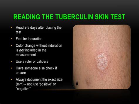 PPT - Tuberculin skin Testing Mantoux tuberculin skin test PowerPoint ...