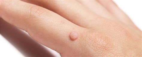 Causes Of Hand Warts