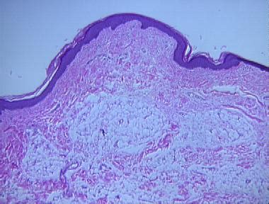 nevus lipomatosus superficialis histopathology - Loma Linda ...