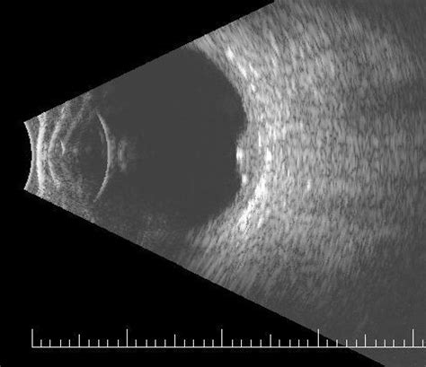 Discrete Choroidal Hemangioma B-Scan - Retina Image Bank