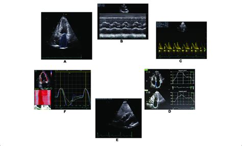 | Illustration of some TTE parameters that will be recorded throughout ...