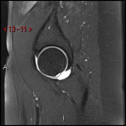 MRI Arthrogram Hip: Rule Out Labral Tear | Cedars-Sinai