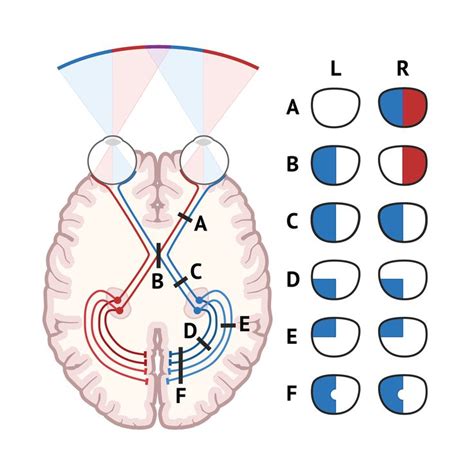 By identifying loss of vision in a particular field or group of fields ...