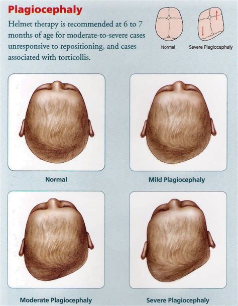 Plagiocephaly how to prevent flat head in babies – Artofit