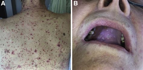 Hepatitis, Pancreatitis and Rash in a Patient With Chronic Lymphocytic ...