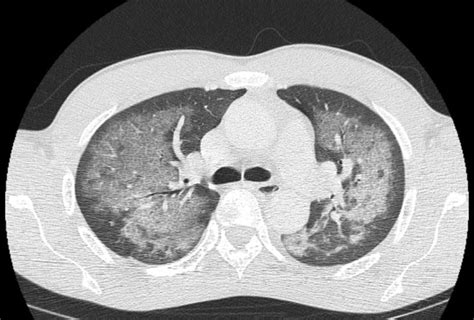 emDOCs.net – Emergency Medicine EducationEM@3AM: Crack Lung - emDOCs ...