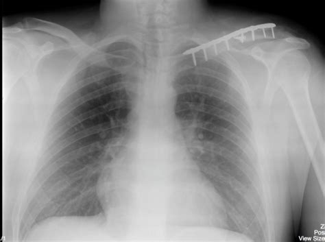 Clavicle Fracture – Undergraduate Diagnostic Imaging Fundamentals