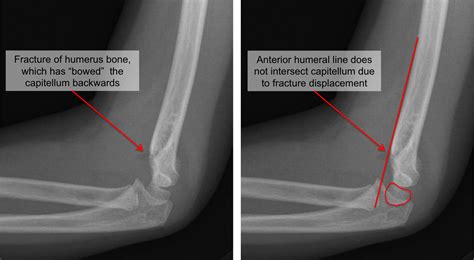 Kid's Elbow Fracture - Raleigh Hand Surgery — Joseph J. Schreiber, MD