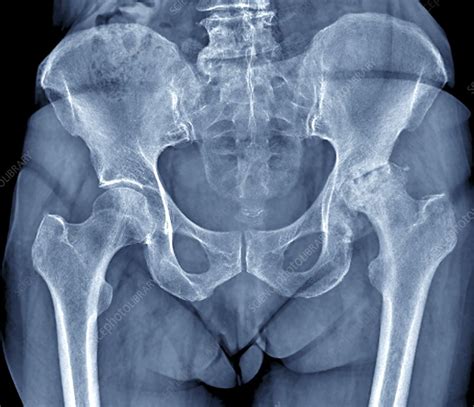 Osteoarthritis of the hip, X-ray - Stock Image - C001/5211 - Science ...