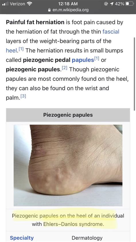 Piezogenic Pedal Papules