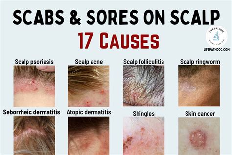 Scabs and Sores on Scalp: 17 Causes, Pictures and Treatment