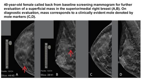 Radiologists Explain Why Skin Lesions are Still Problematic in 3D ...