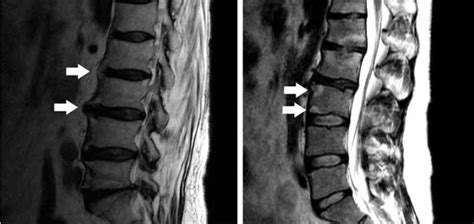 Making sense of MRI of the lumbar spine