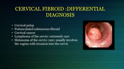 Cervical and broad ligament fibroid