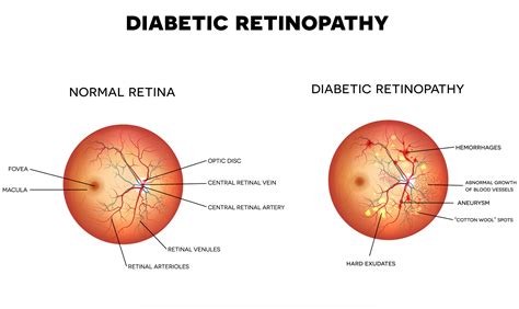 Diabetic Eye Exam for patients with Diabetes