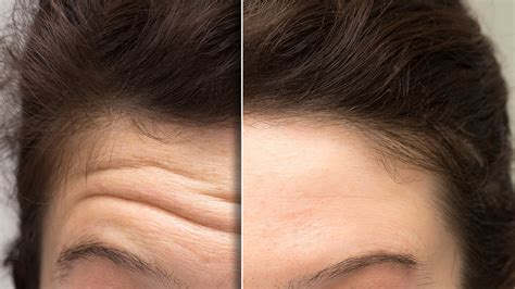 Best Forehead Wrinkle Creams on the Market | Us Weekly