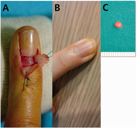 Glomus Tumor Finger