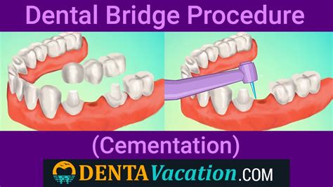 Dental Bridge Procedure: Step By Step - Dental Clinic