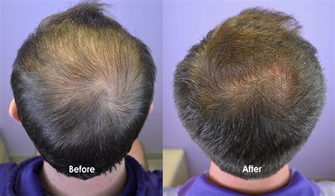 Low Dose Minoxidil Pill Prescribed For Early Hair Loss - Hair ...