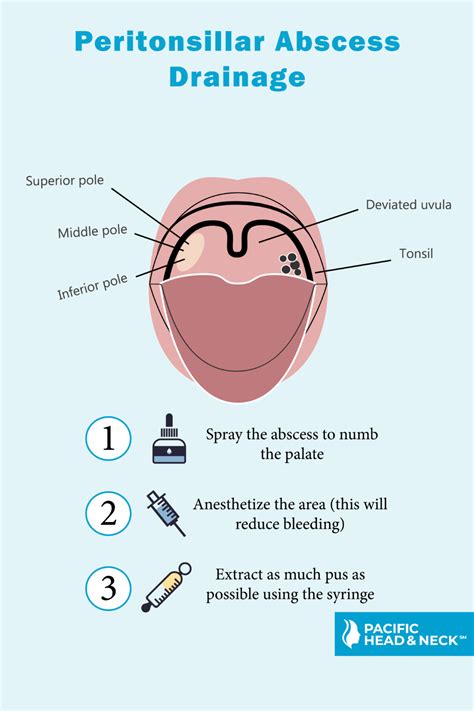 Peritonsillar Abscess - Pacific Eye & Ear Specialists