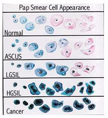 Abnormal Pap Smear Hpv