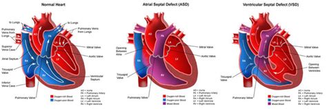 heart disease - Congenital Heart Defect