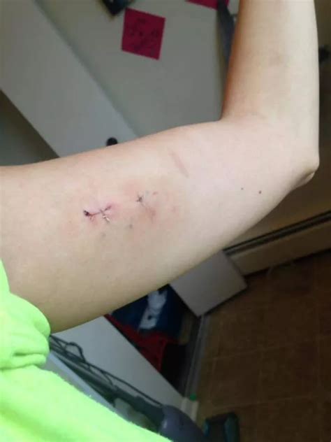 Birth control implant goes MISSING in young mum's arm for five months ...