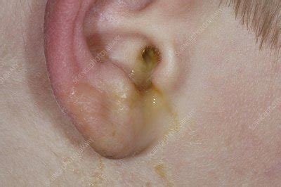 Perforated eardrum with infection - Stock Image - C004/2400 - Science ...