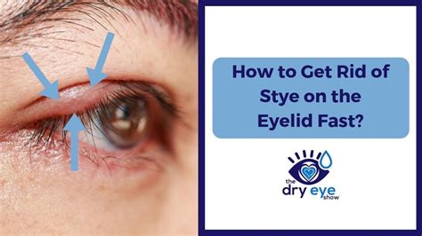 What Causes Stye On Eyelid Fast? - Latest News