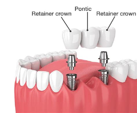 Dental Implant Bridge Fabrication