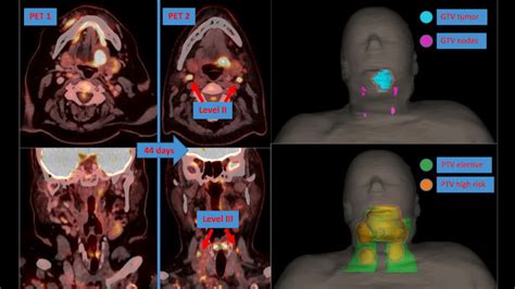 Second-look PET/CT catches cancer spread