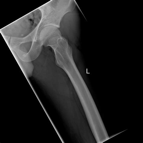 Normal hip xray femoral neck fracture xray - ctmens