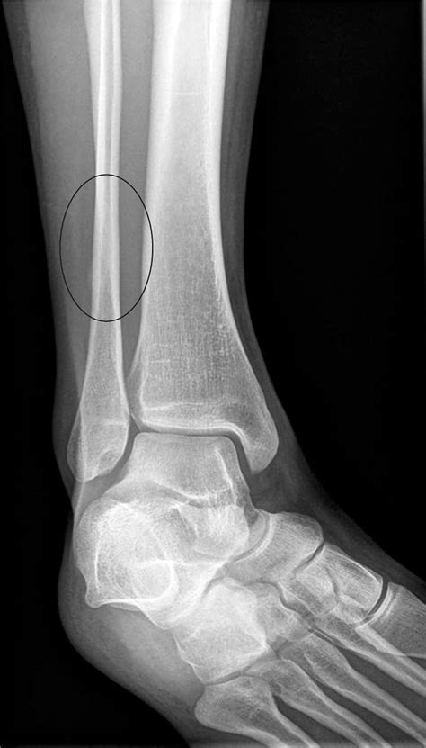 Fibula Stress Fracture Mri | Images and Photos finder